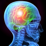 traumatic brain injury