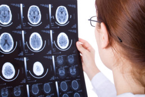 What Is the Lifetime Cost of a Traumatic Brain Injury?