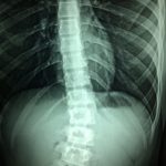 spinal cord x ray