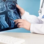 What Are the Signs of a Concussion After a Car Crash in CA?
